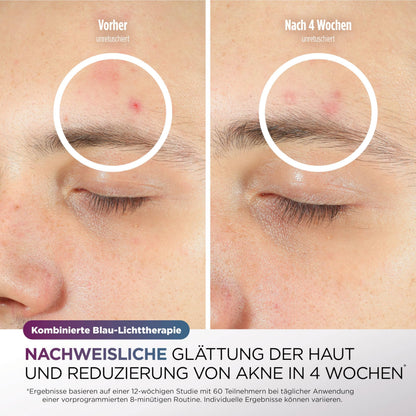 Shark CryoGlow LED Lichttherapie Maske mit Kühlfunktion – FW312EUPL