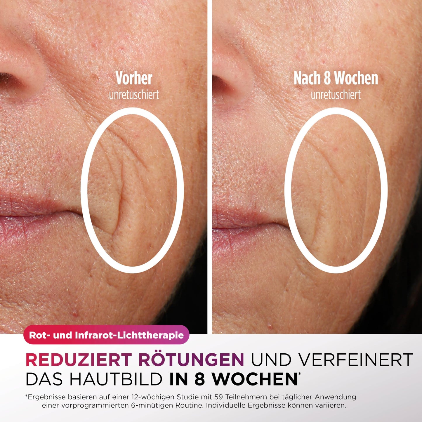 Shark CryoGlow LED Lichttherapie Maske mit Kühlfunktion – FW312EUPL